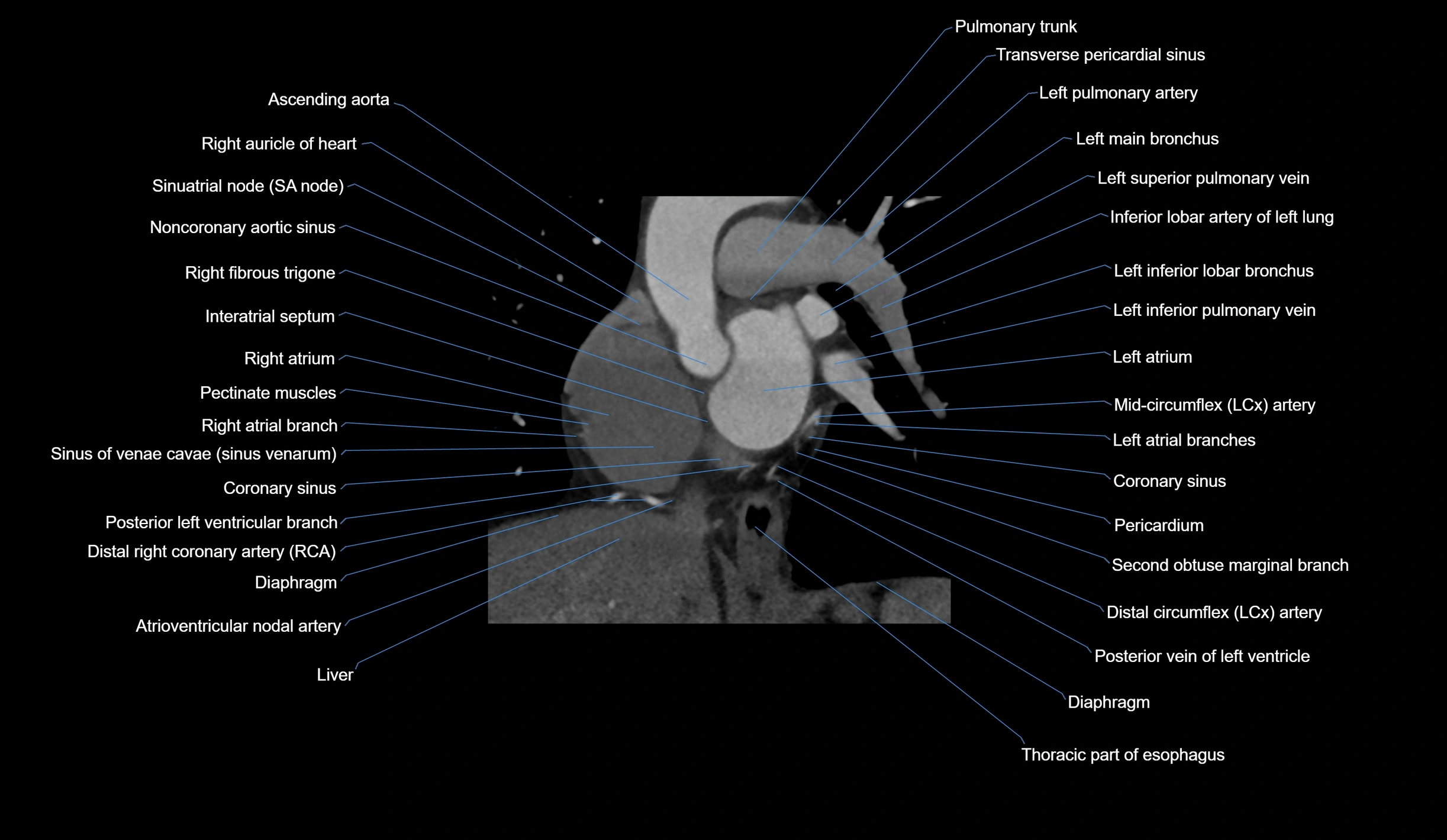 CT heart (coronary angiogram) short axis view  cross sectional anatomy labelled radiology image-00016.webp